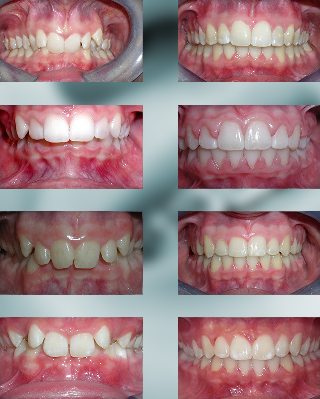 Overbite Teeths