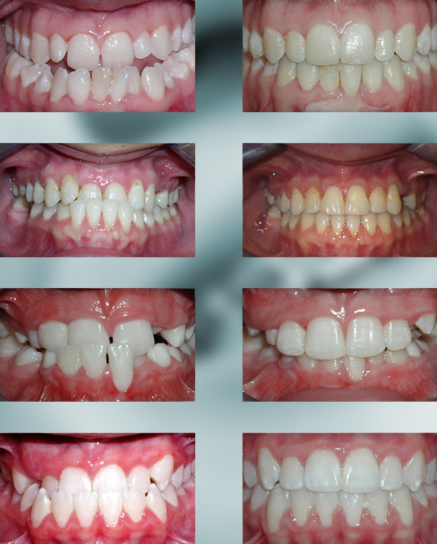 Underbite Teeth